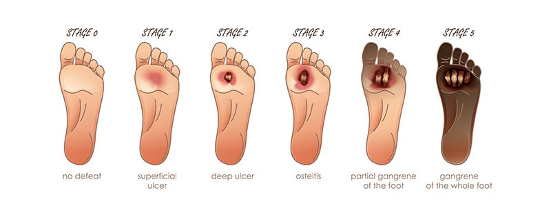 diabetic foot ulcer