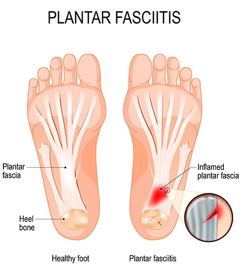 Diagram comparing healthy foot to foot with plantar fasciitis