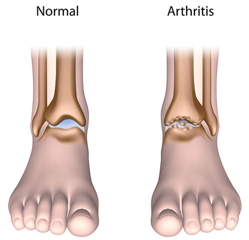 Illustration comparing healthy ankle joint with arthritis ankle joint