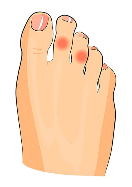 Illustration of a foot with corns