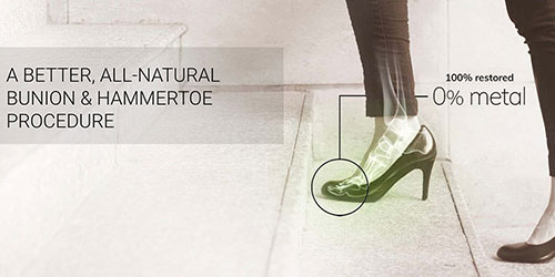 “All-Natural” Bunion & Hammertoe Surgery is Here