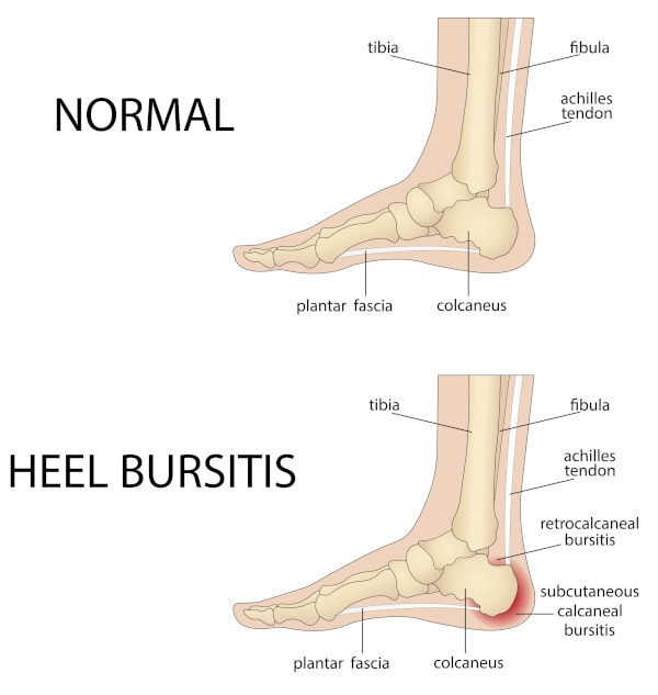 Diagram of normal heel versus heel bursitis