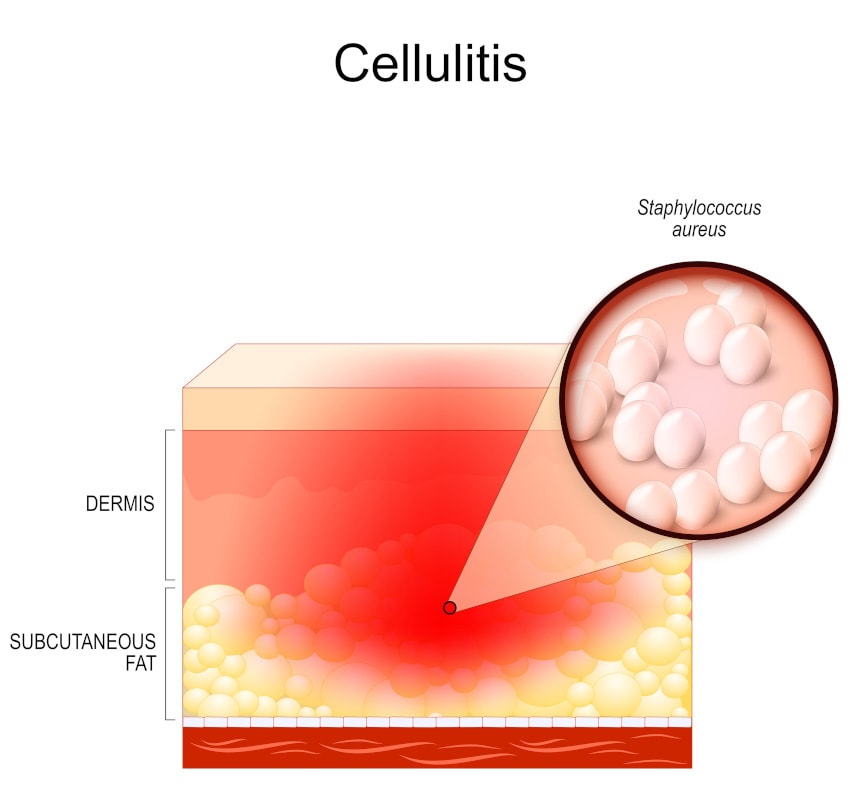 Illustration of cellulitis - showing staph bacteria in deep skin layer