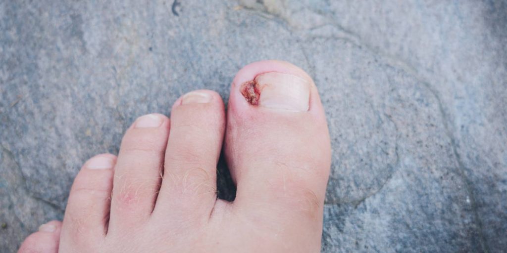 Infected Ingrown Toenail