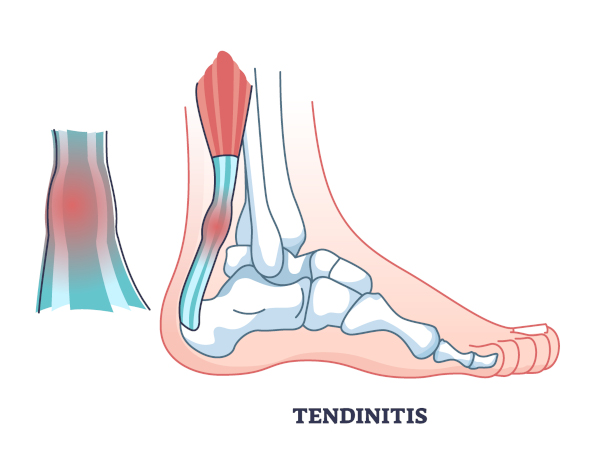 Achilles Tendonitis