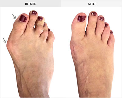 Bunion before and after picture
