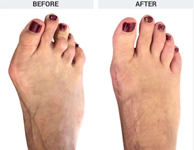 Lapidus Bunion Surgery, Forever Bunionectomy, Santa Monica Foot and Ankle Surgeon
