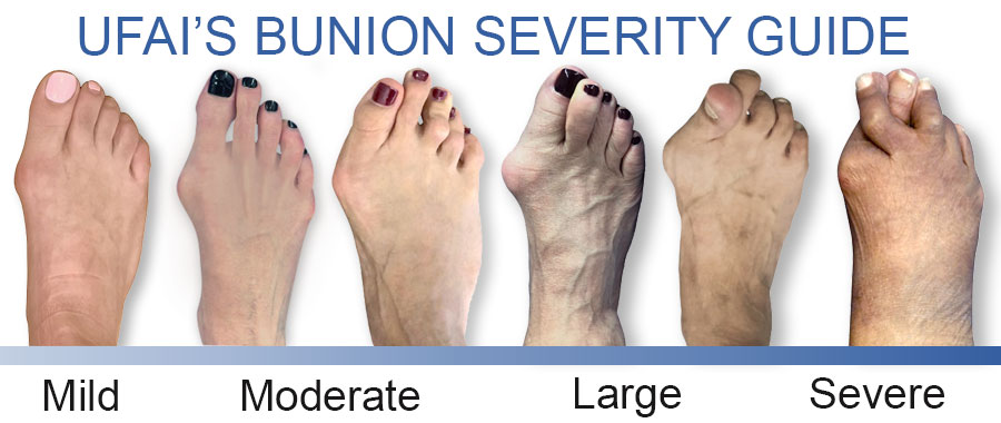 How severe is my bunion?, Best Bunion Surgeons Los Angeles