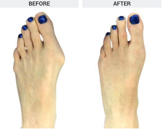 Minimally invasive bunion surgery before and after images