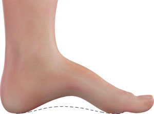 Cavus Foot, high arches, University foot and ankle institute