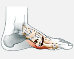 Charcot Foot, Diabetic Conditions University Foot and Ankle Institute