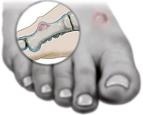 Ganlgion Cyst, University Foot and Ankle institute