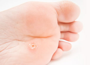 Plantar Wart, Univeristy Foot and Ankle Institute