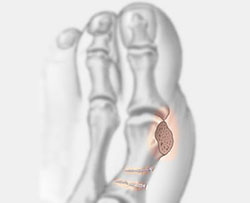 Failed Hammertoe - University Foot and Ankle Institute