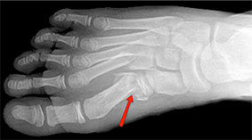 Metatarsal fracture, University foot and ankle institute