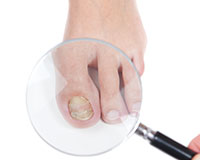 Ingrown toenail treatment, University Foot and Ankle Insitute