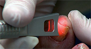 Nail Fungus is treated painlessly with a special laser