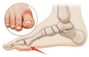 What is Turf Toe, University Foot and Ankle Institute