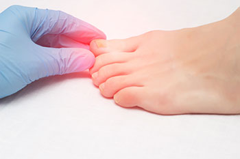 onychogryphosis, University foot and ankle institute