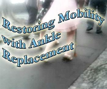 Ankle replacement restores mobility for many.