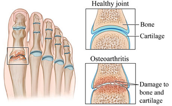 Big Toe Arthritis - University Foot and Ankle Institute - Los Angeles