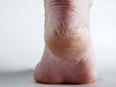 foot disease new dry feet