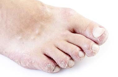 Pitted Toenails, University Foot and Ankle Institute