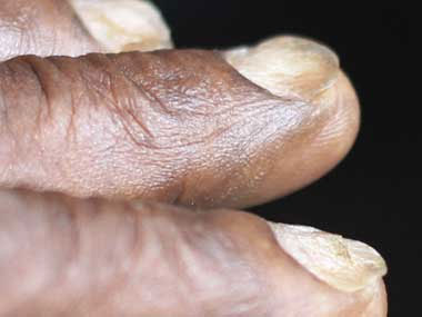 Spooned Nails and Lupas and Anemia, University Foot and Ankle Institute
