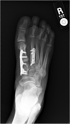 Preoperative anteroposterior radiograph of the right foot, University Foot and Ankle Institute and Dr. Ryan Carter