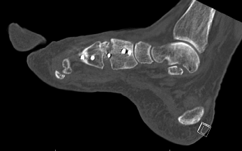 Dr, Carter, University Foot and Ankle Institute, Preoperative sagittal computed tomography scan of the right foot confirming nonunion with bony resorption at the autograft implantation site.