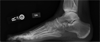 Preoperative lateral radiograph, University Foot and Ankle Institute, Dr. Ryan Carter