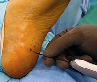 Topaz Procedure for Plantar Fasciitis- University Foot and Ankle Institute